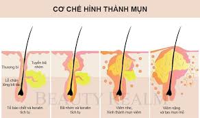 Xử trí mụn trứng cá