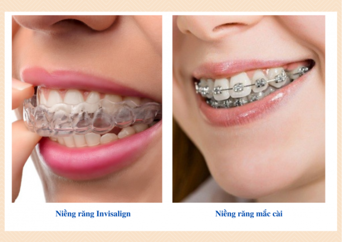 Lý do niềng răng Invisalign được ưa chuộng